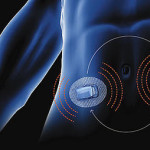 Are Artificial Pancreas vulnerable to cyber attacks?Security Affairs